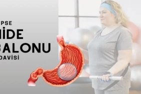 Mide Balonu Taktıranlar