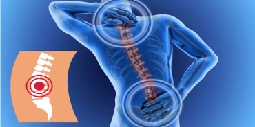 Bel Kayması Ameliyatı Sonrası Yaşam: Kalıcı Çözüm Mümkün mü?