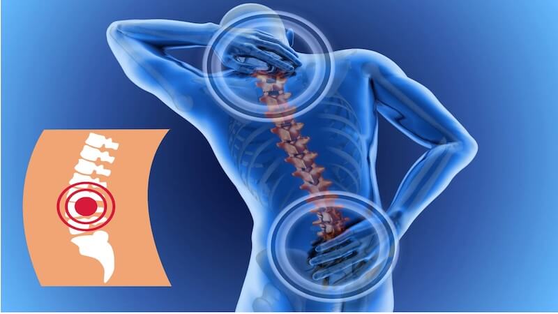 Bel Kayması Ameliyatı Sonrası Yaşam: Kalıcı Çözüm Mümkün mü?